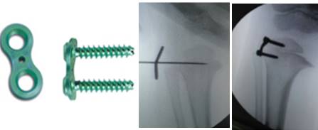 Pernas arqueadas (Doença de Blount) – Dr. Wilson Lino Jr.